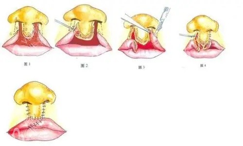 唇裂鼻修复图