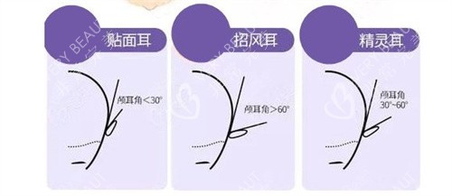 贴面耳招风耳精灵耳区别