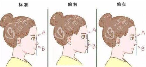 鼻基底凹陷的不同程度