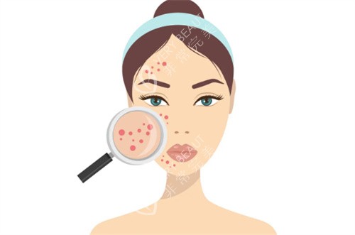 祛痘卡通图片