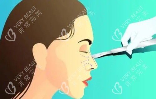 隆鼻失败修复示意图