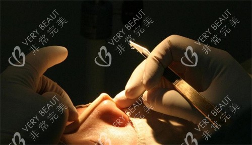 隆鼻整形细节图