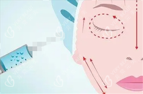 玻尿酸面部填充示意图