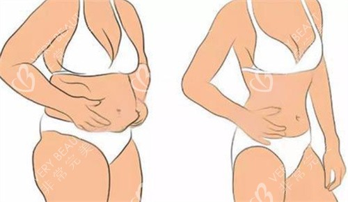 吸脂前后卡通图