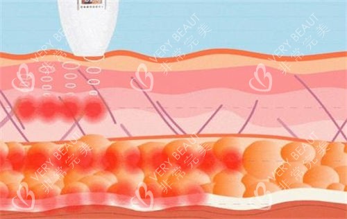 超声炮仪器作用在皮肤侧剖图