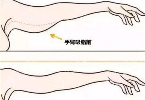 手臂吸脂