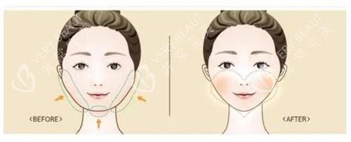 磨骨手术前后的区别 磨骨手术前后的区别