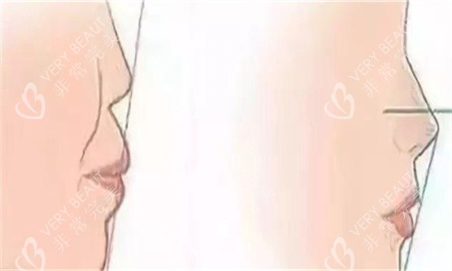 隆鼻前后侧面对比