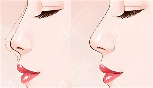 隆鼻前后对比动画图 隆鼻前后对比动画图
