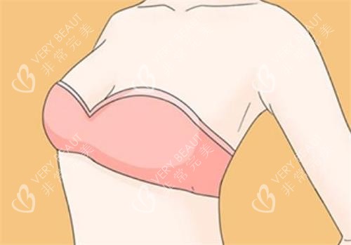 隆胸术后成效图