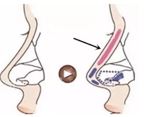 分段式隆鼻示意图