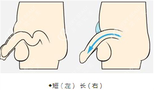 阴茎增长手术前后演示动画图