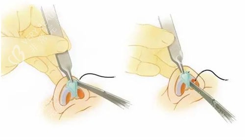 隆鼻手术鼻头过程展示图
