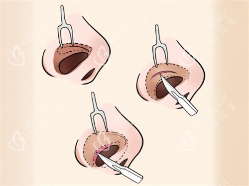 鼻孔缩小手术过程