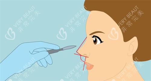 鹰钩鼻矫正图示