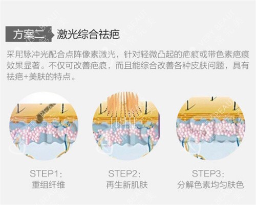 激光祛疤图示