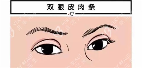 双眼皮肉条痕图 双眼皮肉条痕图