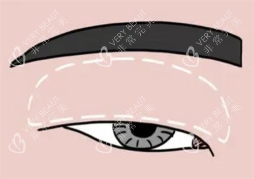 肿眼泡做双眼皮对比示意图 肿眼泡做双眼皮对比示意图