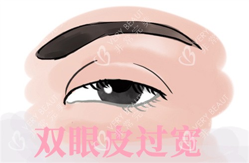双眼皮过宽修复 双眼皮过宽修复