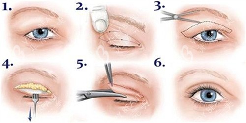 双眼皮全切术过程图 双眼皮全切术过程图