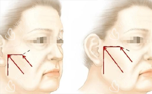 微拉美面部提升方向