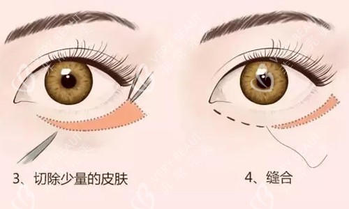 外切祛眼袋展示图