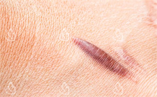 疤痕疙瘩2 疤痕疙瘩2