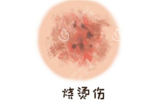 烧烫伤疤痕 烧烫伤疤痕