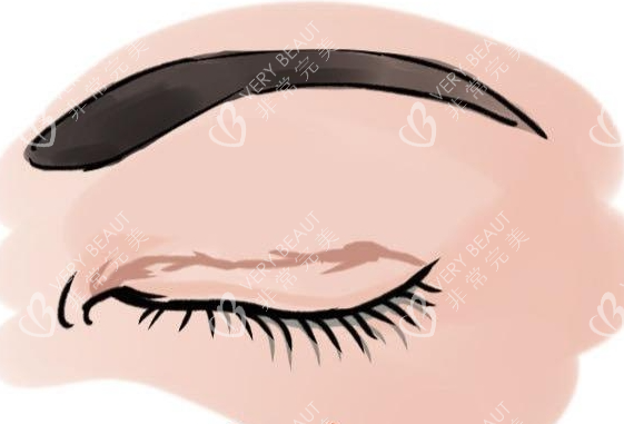 眼角增生疤痕动画展示图 眼角增生疤痕动画展示图