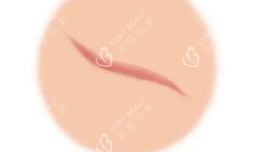 疤痕增生的不同动画展示图 疤痕增生的不同动画展示图