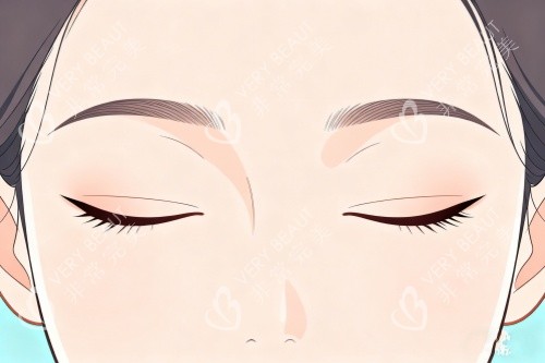 割双眼皮成果图