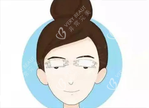 双眼皮术后