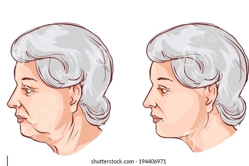 颈部拉皮卡通图