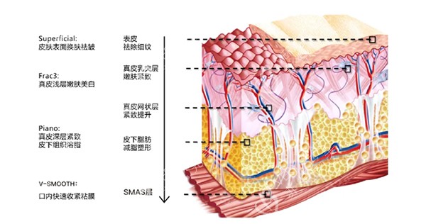 欧洲之星fotona4d皮肤层级照片