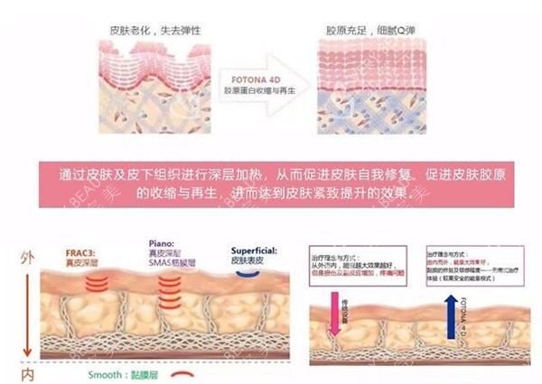 欧洲之星fotona4dpro改善皮肤示意图