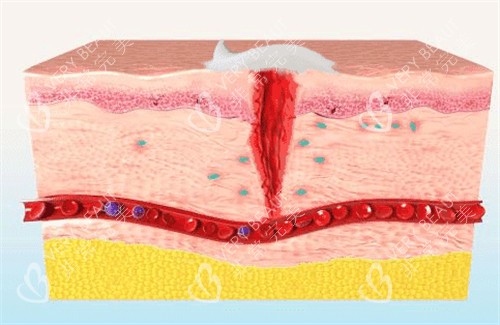 生长因子可以促进皮肤疤痕修复