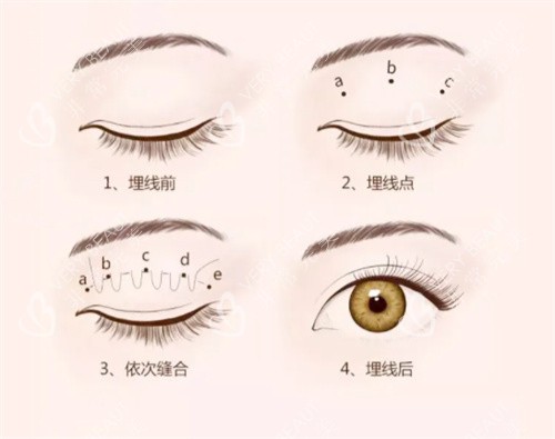 双眼皮埋线过程图 双眼皮埋线过程图