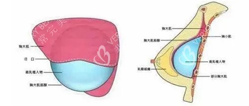 假体隆胸胸部切口卡通示意图 假体隆胸胸部切口卡通示意图
