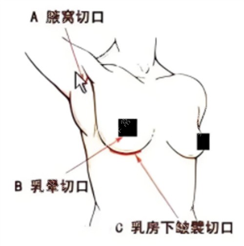 假体隆胸手术切口位置 假体隆胸手术切口位置