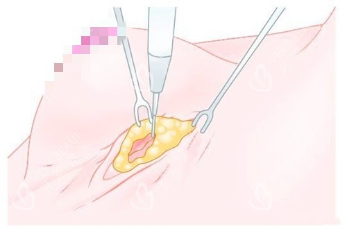 乳房下皱襞切口 乳房下皱襞切口