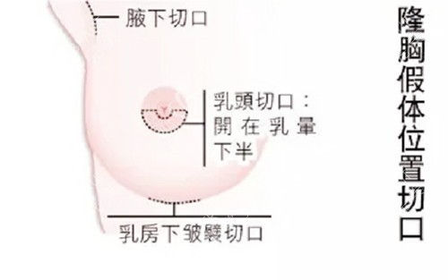 乳房下皱襞切口图 乳房下皱襞切口图