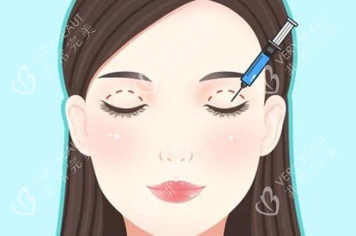 做双眼皮示意图