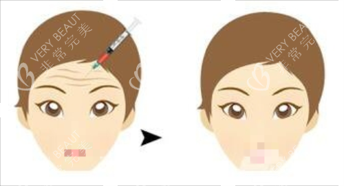 打针除皱前后对比图 打针除皱前后对比图