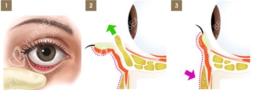 眼袋手术图解