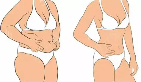 腹部塑形手術(shù) 腹部塑形手術(shù)