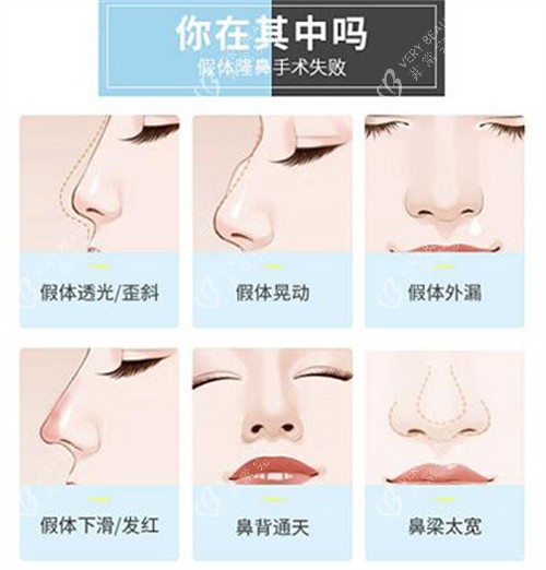 哪些鼻子需要做修复改善