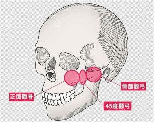 颧骨内推从3万到10万差在哪?2026年更新价格避坑指南来了!-非常完美