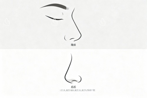鼻子做整形前后对比图