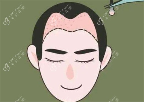 M型发际线种植 M型发际线种植