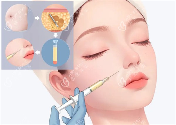 自体脂肪填充整形手术图片